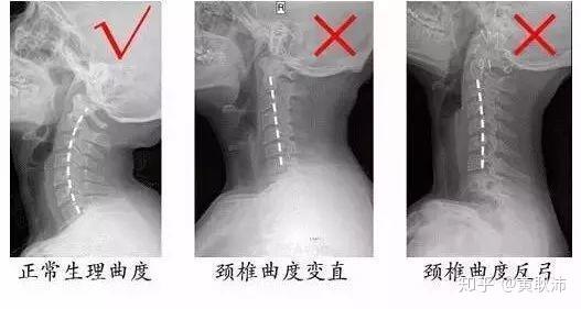 桑柘木命遇上反弓路该如何化解？ 颈椎反弓是什么意思