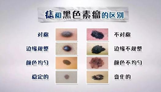 黑色素细胞痣，黑色素痣图 黑素细胞痣